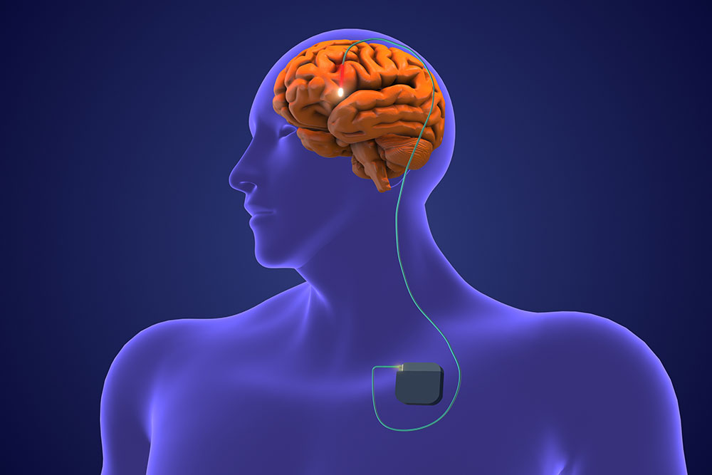A graphic image of DBS, with an electrode implant in the brain that connects to a pacemaker-like device in the chest.